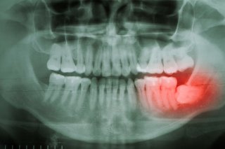 impacted wisdom tooth extraction needed oral surgeon